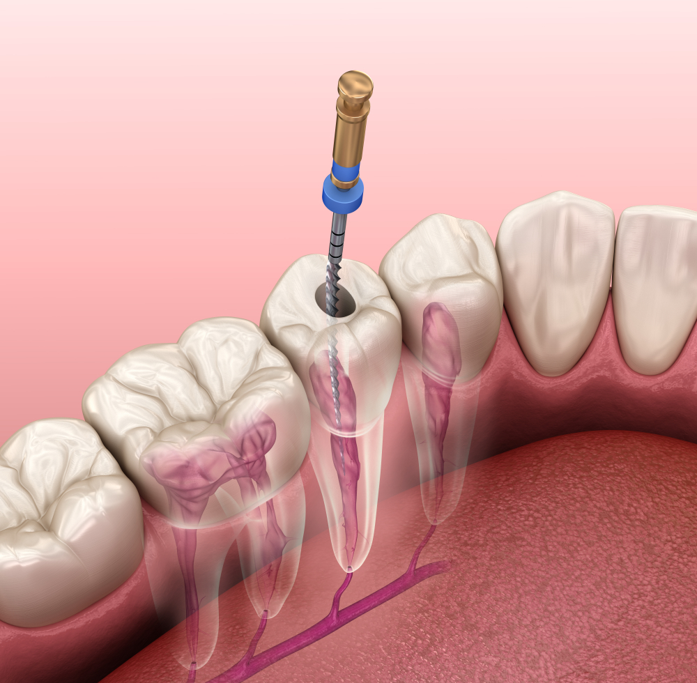 Electiva XV: Endodoncia en dientes posteriores 